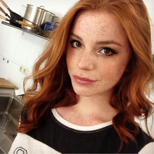 freckles
